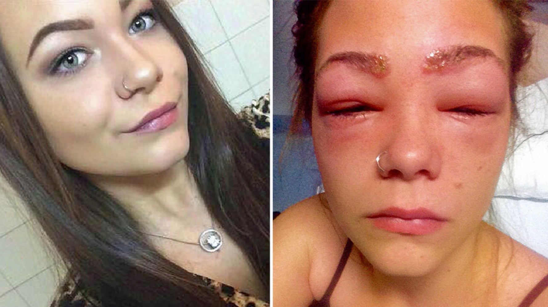 Teen Almost Blinded After Suffering Horrific Reaction To Eyebrow Dye Huffpost Uk Life