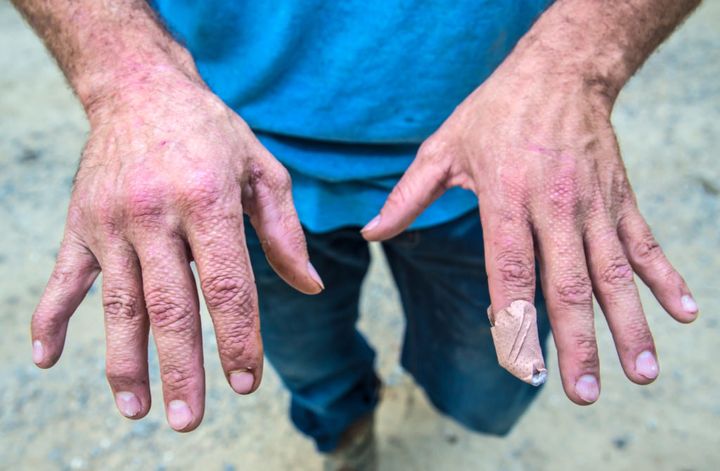 Bram Ates shows the skin grafts on the backs of his hands. Ates used his hands to shield his face when an explosion erupted at a VT Halter shipyard.