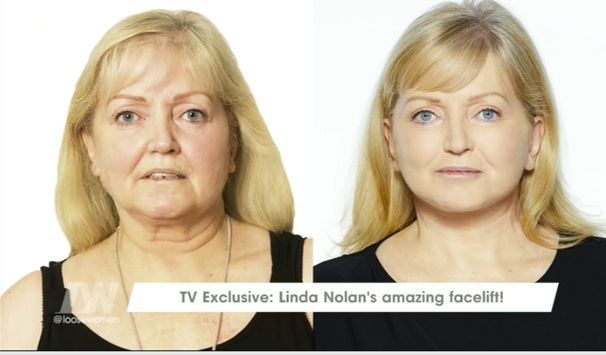 Linda before (L) and after (R)