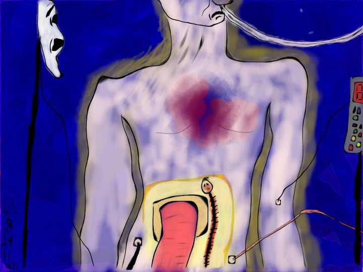 <p><em>First Surgery</em> (2011) A depiction of what I was like when I was in ICU recovering from that first surgery. My intestine was coming out of my body (I had an ileostomy), along with 5 or 6 tubes.</p>