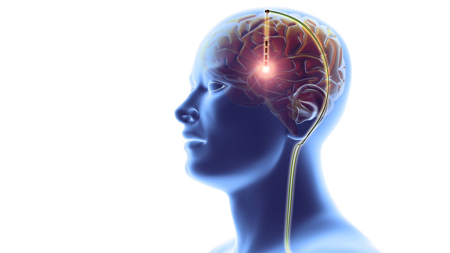 Scientists Test Deep Brain Stimulation As Potential Anorexia