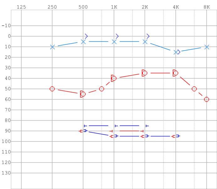 An audiogram showing characteristic hearing loss among Meniere’s disease patients.