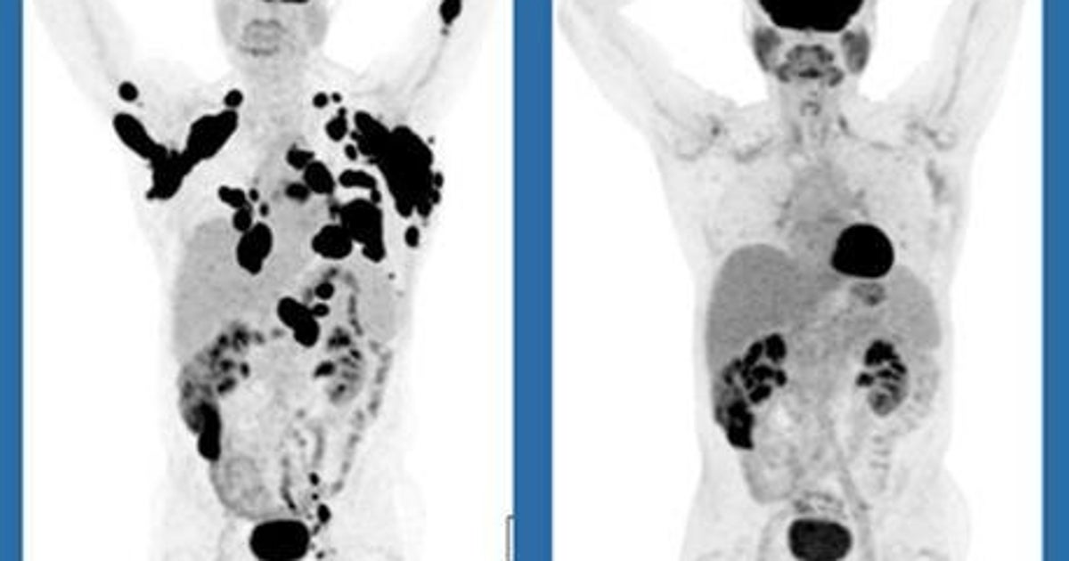 Terminal Cancer Patients Go Into Complete Remission After