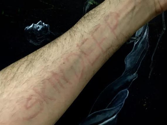 <p>Dermatographic urticaria, or simply dermatographia (skin writing), often is a primary indicator of a mast cell disorder. Here, I lightly scratched the words “skin deep” onto my forearm with a paperclip. Within a couple of minutes, the words appeared faintly pink. A couple more minutes and they were clearly etched in raised, red scar-type skin.</p>