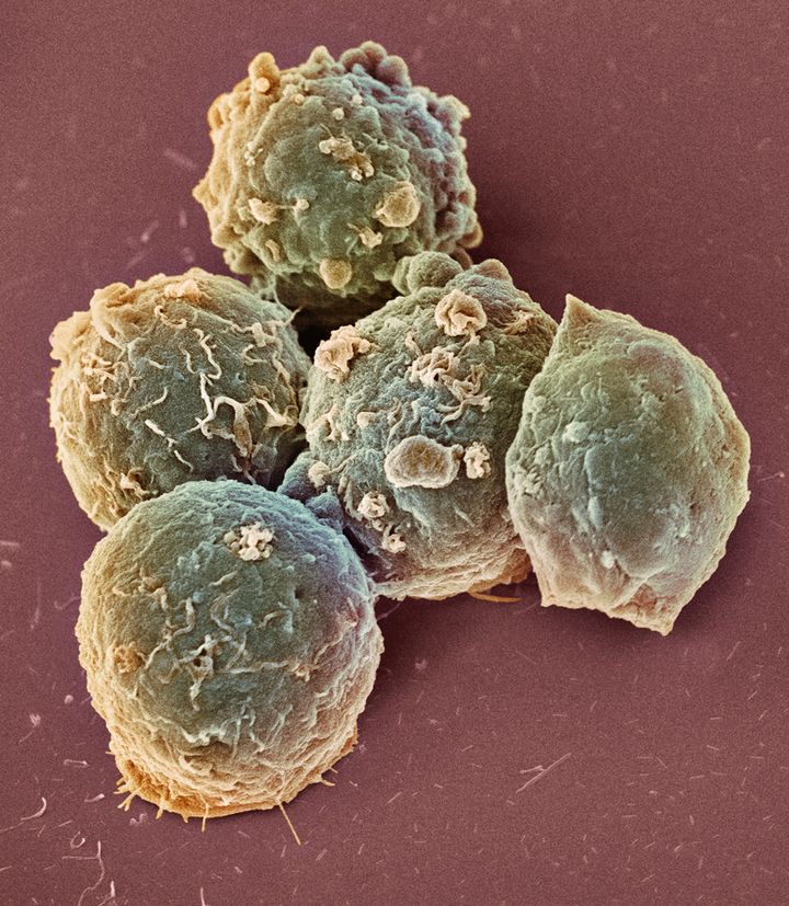 Lymphoma cells. Coloured scanning electron micrograph (SEM) of lymphoma cancer cells grown in culture.