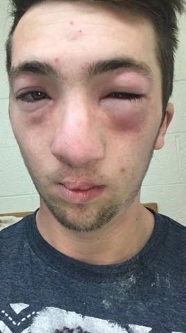 The mother of a university student with a peanut allergy says fraternity members smeared peanut butter on his face during a hazing ritual last fall.