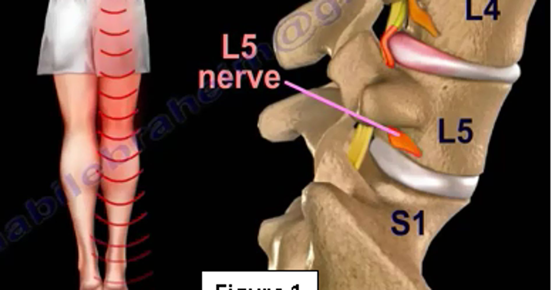 Piriformis Syndrome or True Sciatica: Are They The Same or Different ...