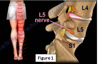 Piriformis syndrome or disc herniation, how do you tell the