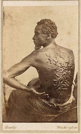 The Scourged Back of "Gordon" an escaped slave from Louisiana, March 1863
