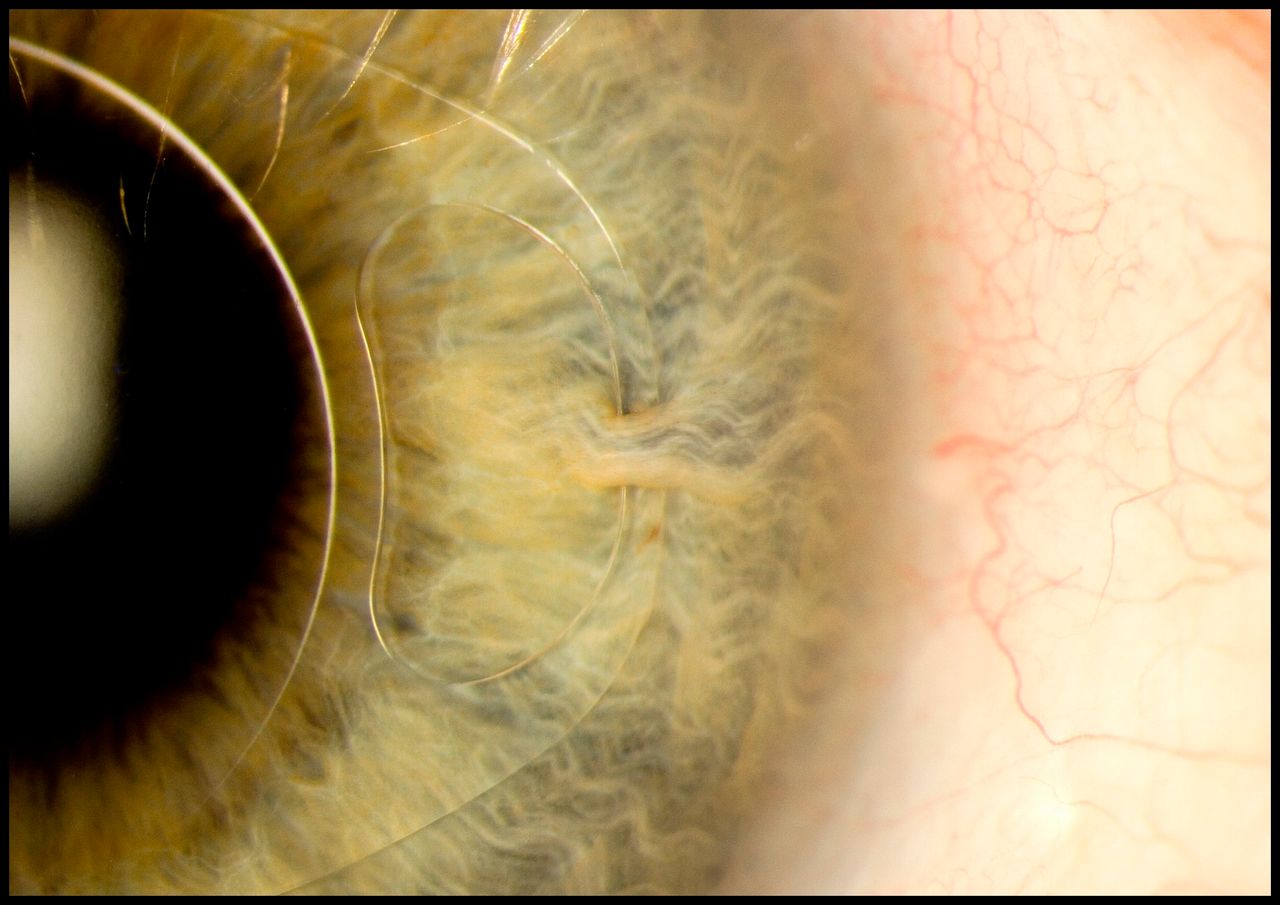 This image shows how an iris clip also known as an artificial intraocular lens fitted onto the eye. Its used to treat conditions such as myopia and cataracts. 