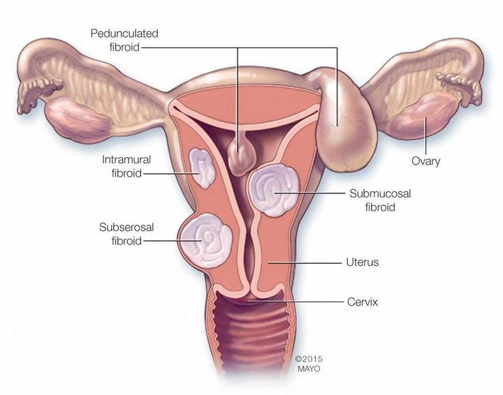 There are three major types of uterine fibroids. Intramural fibroids grow within the muscular uterine wall. Submucosal fibroids bulge into the uterine cavity. Subserosal fibroids project to the outside of the uterus.