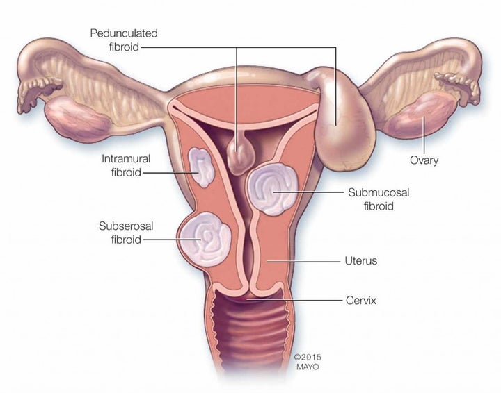 <p>There are three major types of uterine fibroids. Intramural fibroids grow within the muscular uterine wall. Submucosal fibroids bulge into the uterine cavity. Subserosal fibroids project to the outside of the uterus.</p>