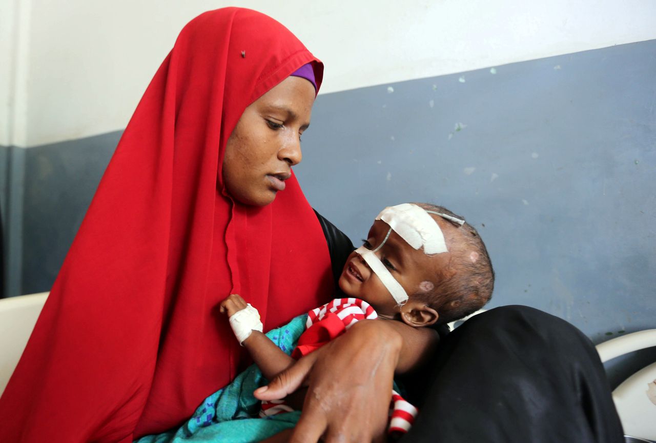 A Somali woman holds her malnourished child fitted with a nasogastric tube inside a ward at the Banadir hospital on March 5.