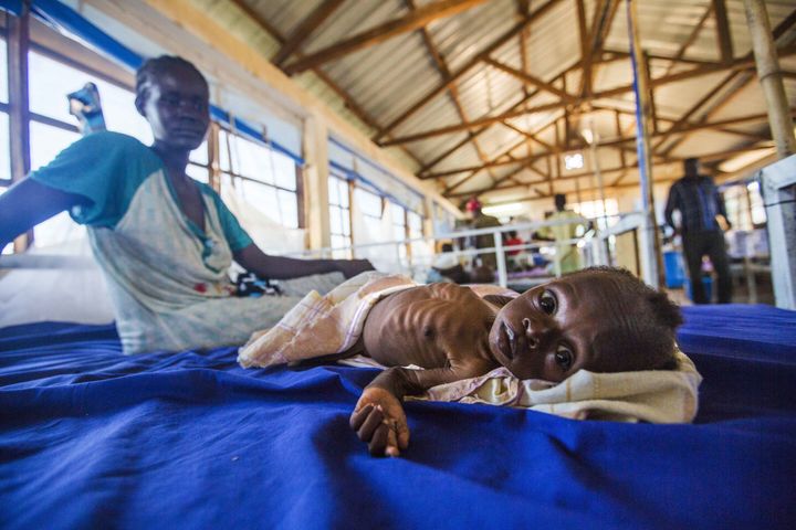 A severely malnourished 2-month-old girl lies in a hospital bed next to her mother. In February, South Sudan declared the world's first famine in six years.