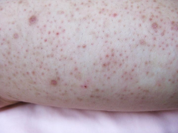 Here's You Get Those Little Bumps On | HuffPost Life