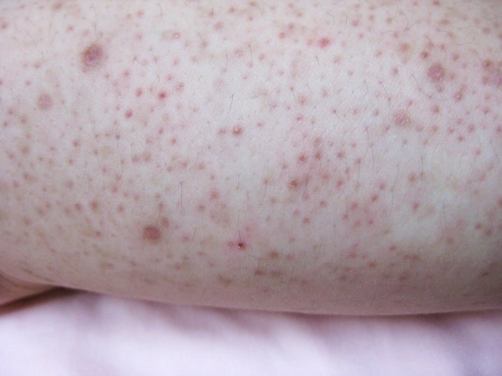 A close up of a case of keratosis pilaris.