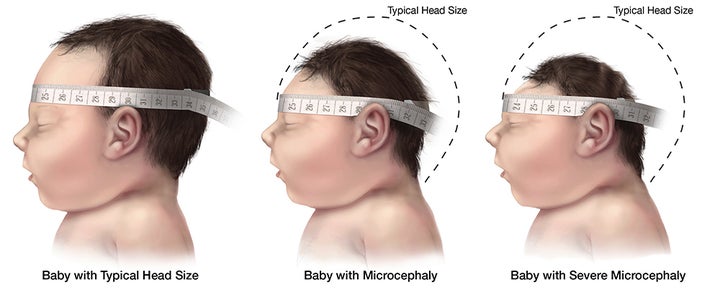 <p>Baby with typical head size vs. baby with microcephaly and severe microcephaly</p>