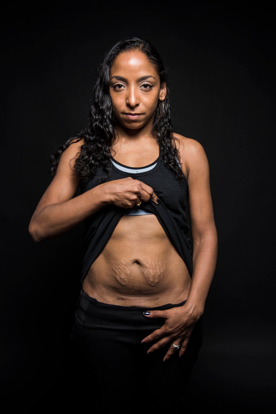 Women are sharing c-section scar selfies to challenge perceptions