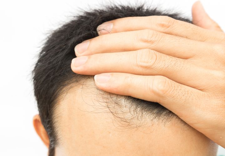 Hair Loss Drugs Linked To Depression And Erectile Dysfunction | HuffPost  Life