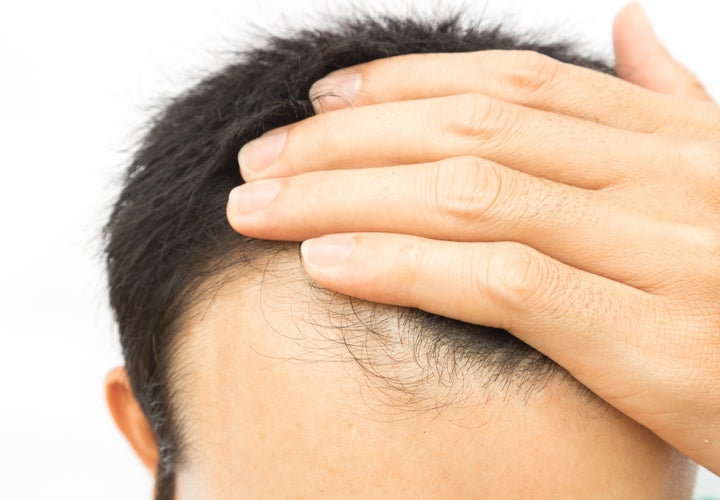 Hair Loss Drugs Linked To Depression And Erectile Dysfunction | HuffPost Life Hair Loss Drugs Linked To Depression And Erectile Dysfunction | HuffPost Life