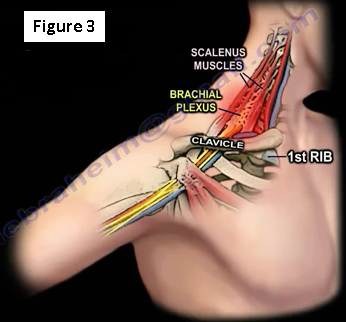 Structures and Spaces  Center for Thoracic Outlet Syndrome