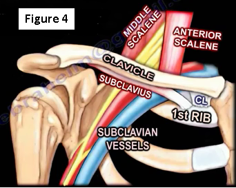 The Subclavius Muscle - The Single Most Super Contracted Muscle of Thoracic  Outlet Syndrome - Thoracic Outlet Syndrome