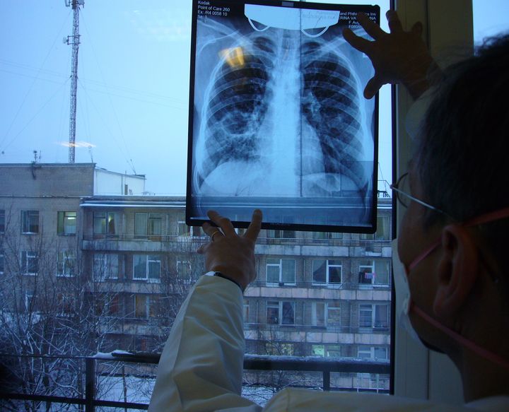 Research Excellence to Stop TB Resistance