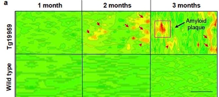 The synchrotron accelerator images of Alzheimer's disease reveal more detail about the earliest stages of the disorder.