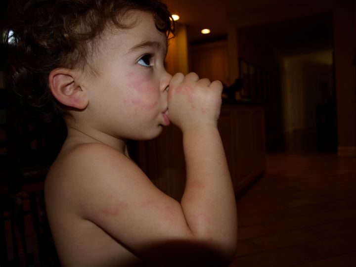 My son Josh, when he came home from the ER after taking a bite of my PB & J. 
