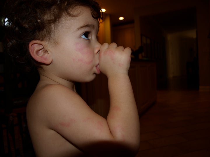 My son Josh, when he came home from the ER after taking a bite of my PB & J. 