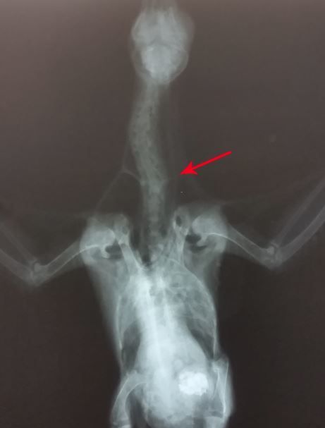 Radiograph showing the broken vertebrae.