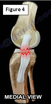 Medial Collateral Ligament Injuries | HuffPost Contributor