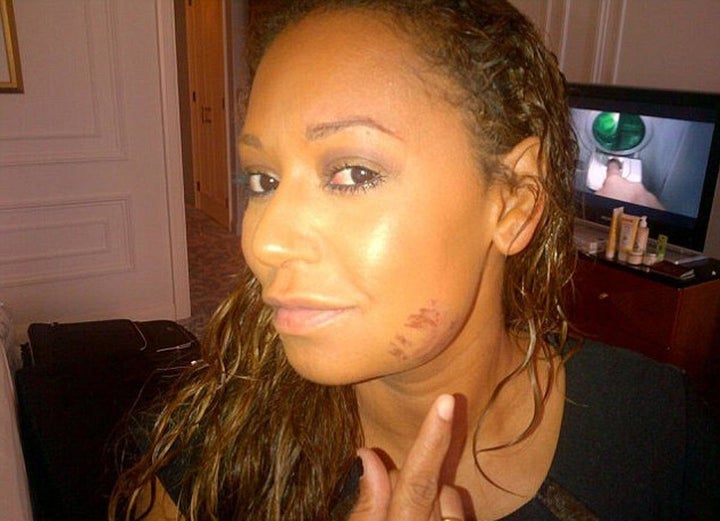 Melanie Brown tweeted this photo of her bruised face in 2012. She now claims her husband punched her and forced her to tweet out a picture about falling in heels.