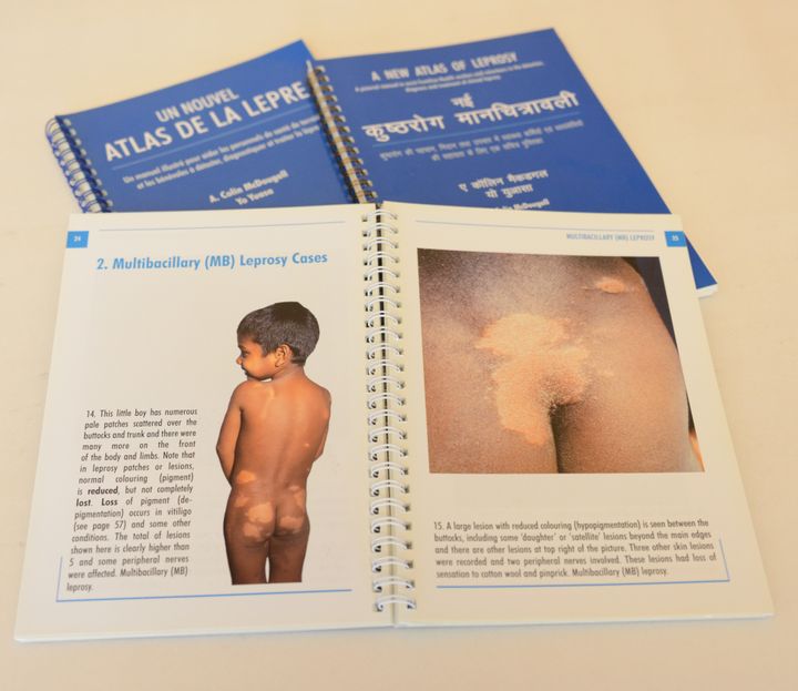 A pictorial manual provided by the Sasakawa Memorial Health Foundation to assist frontline health workers and volunteers to identify the symptoms of leprosy. Published in 7 languages and can be downloaded for free. 