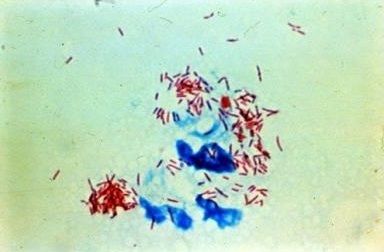 INFECTIOUS DISEASE SURVEILLANCE CENTER (IDSC), JAPAN Mycobacterium Leprae