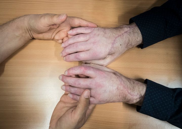 The hands of the UK's first double hand transplant patient Chris King (right). 