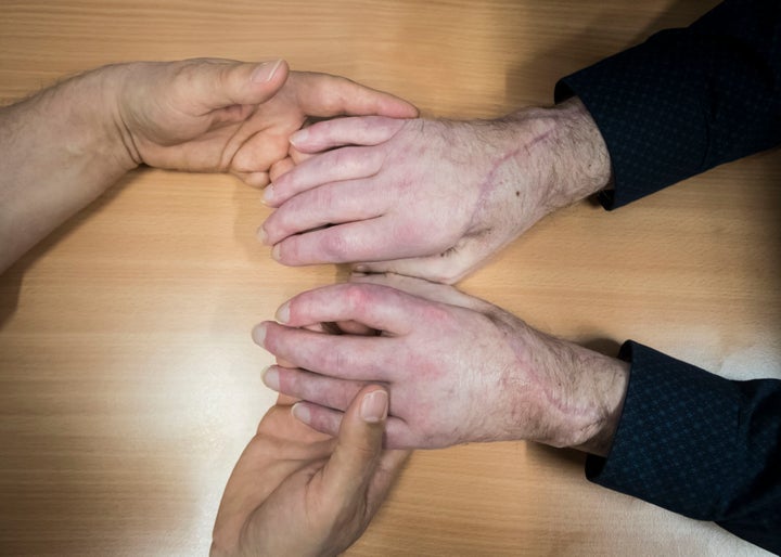 The hands of the UK's first double hand transplant patient Chris King (right).