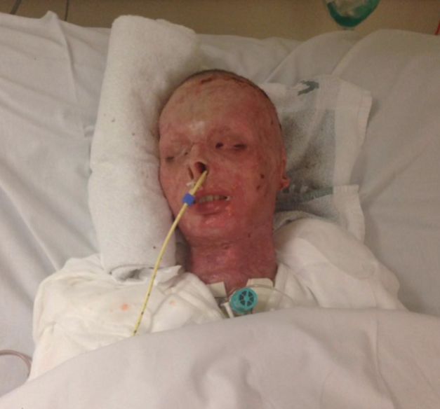 Teen Troy Mackinlay was left with burns on 85% of his body after a house fire 