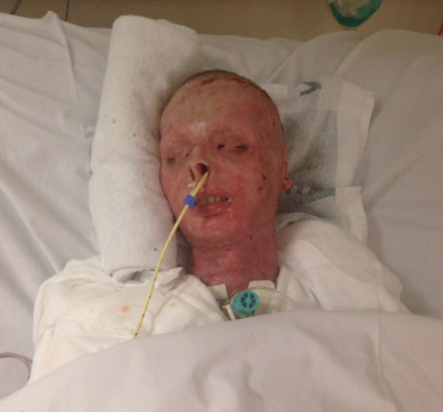 <strong>Teen Troy Mackinlay was left with burns on 85% of his body after a house fire </strong>