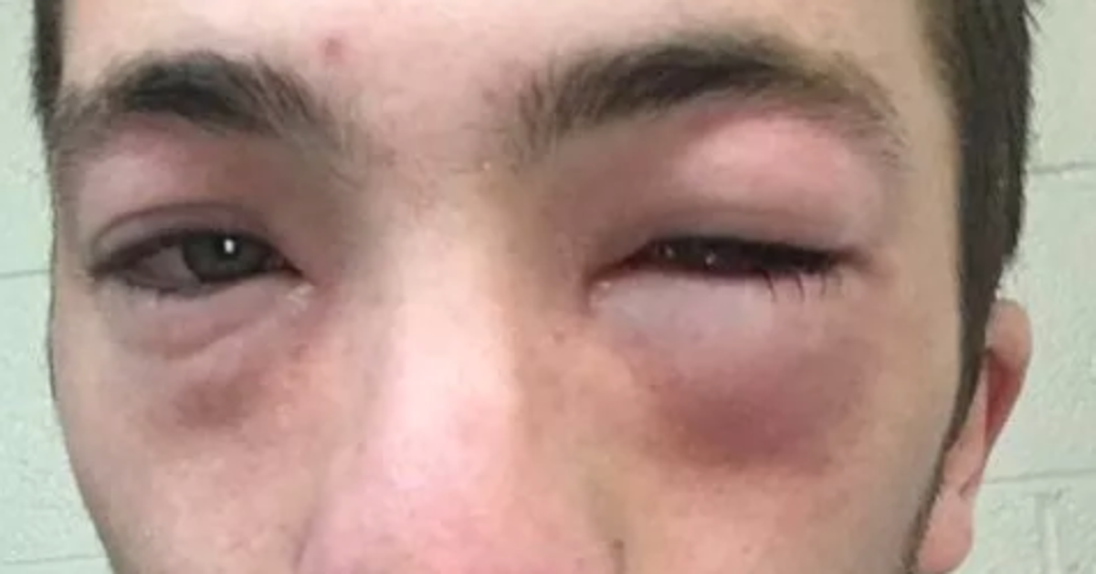 Student Andrew Seely 'Could Have Died' After Peanut Butter Was Spread