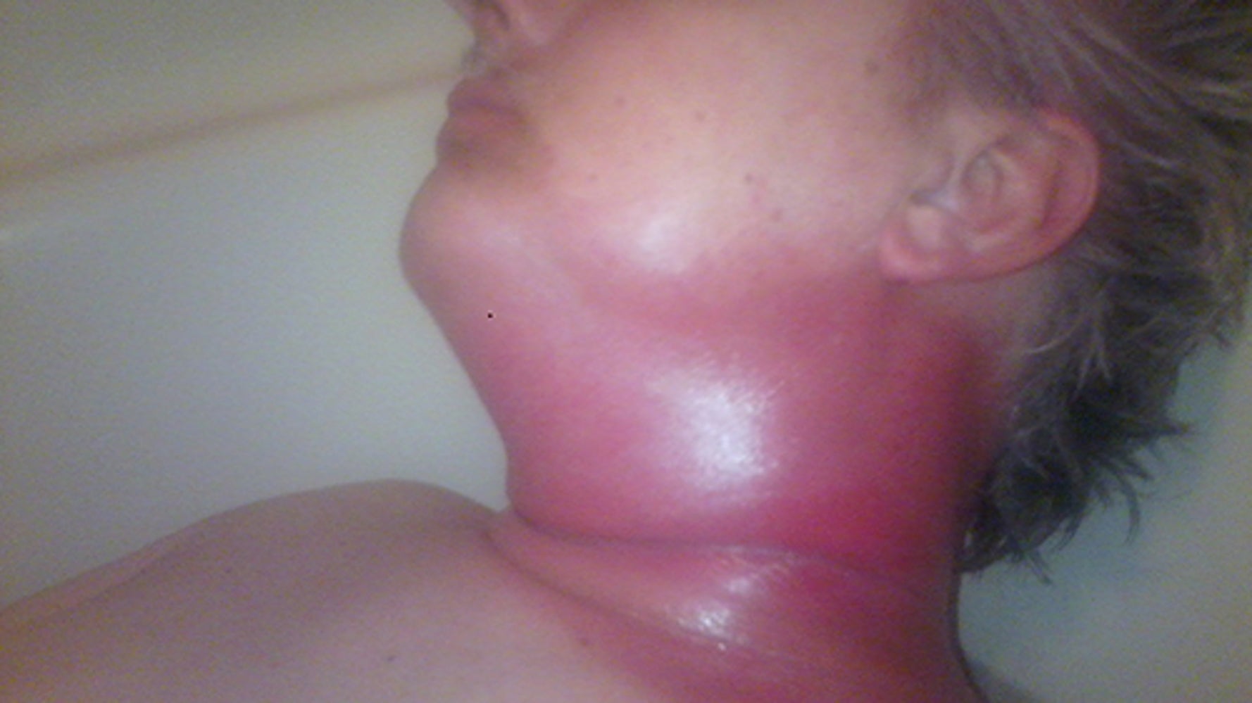 hpv around neck paraziti in organism simptome