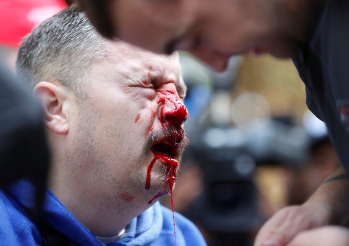 A pro-Trump supporter bleeds after being hit by a counter protester during the Patriots Day Free Speech Rally in Berkeley, California, U.S. April 15, 2017.