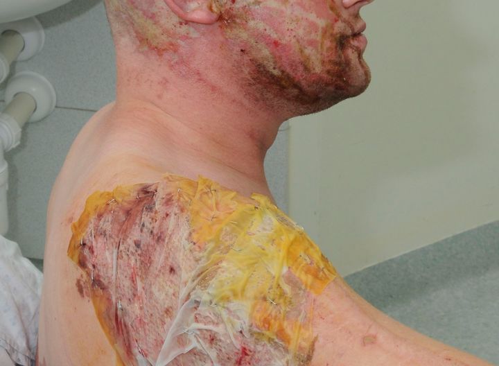Undated police handout of an acid attack survivor (archive photo)