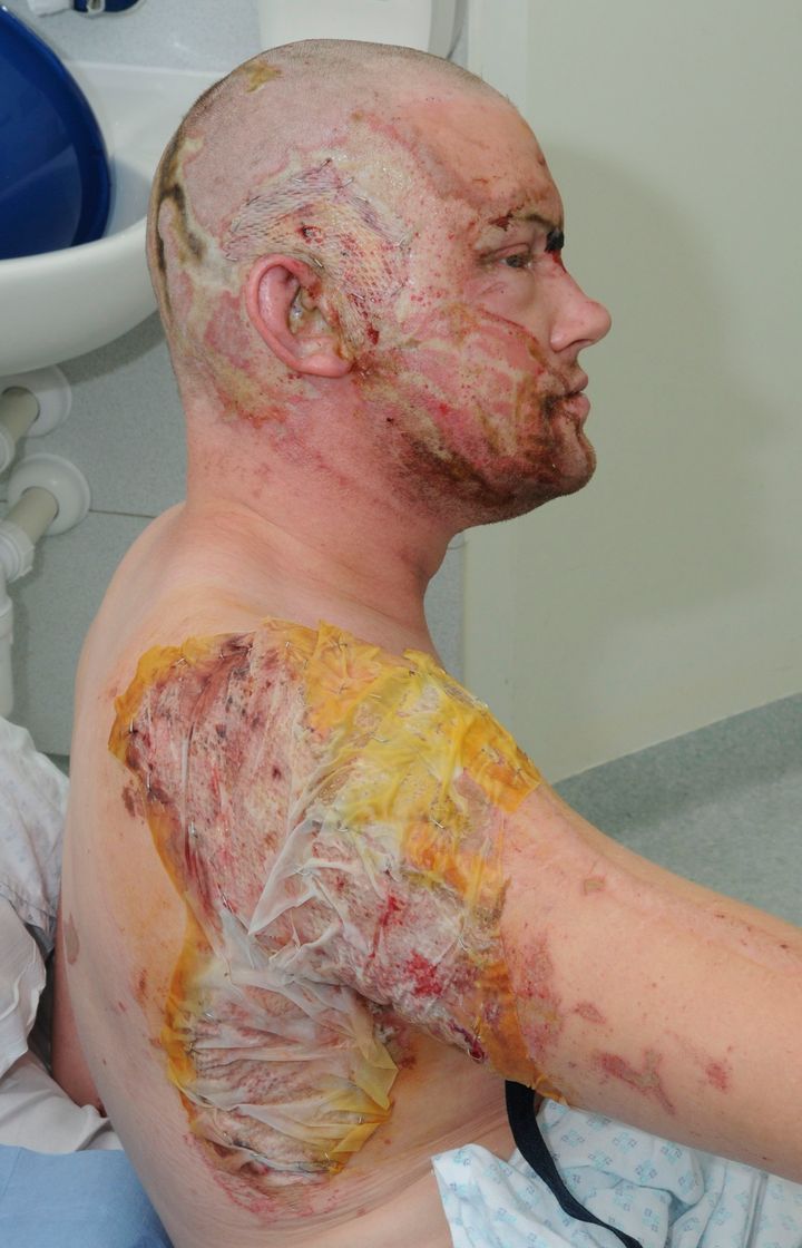 Undated police handout of an acid attack survivor (archive photo)