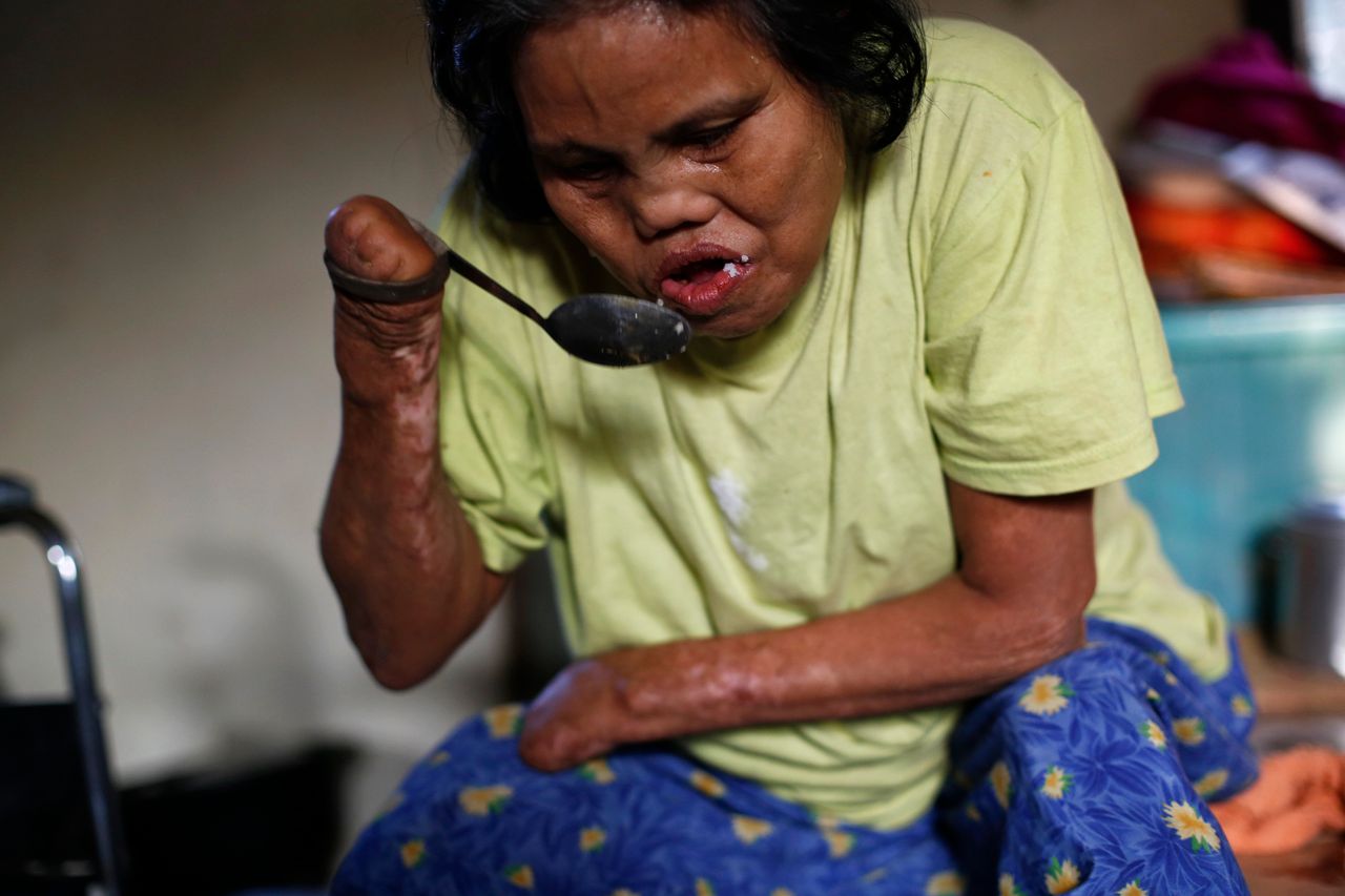 Contrary to popular belief, leprosy does not make body parts fall off. It causes nerve damage, which can lead to secondary injuries and, in severe cases, amputation. 