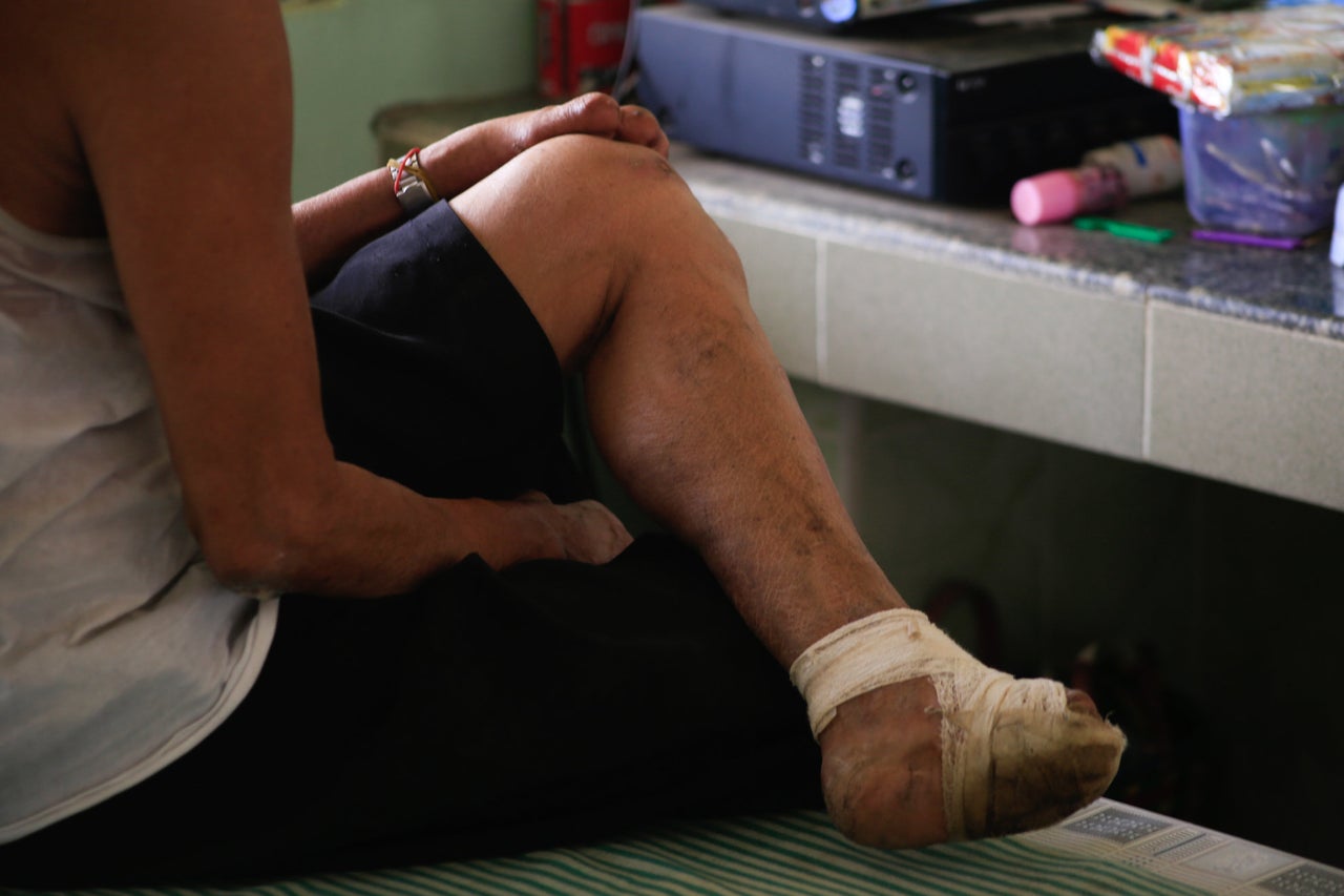 A patient with leprosy, which causes nerve damage and loss of sensitivity. In extreme cases, this can result in secondary injuries that lead to the loss of hands or feet.