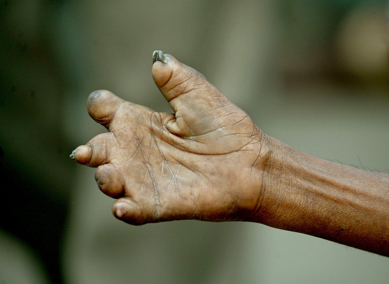 Leprosy can cause curling and shortening of the fingers. 