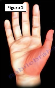 flexor pollicis brevis pain