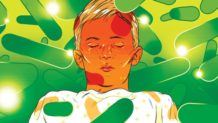 <p>Cartoon illustration of patient with bacterial meningitis </p>