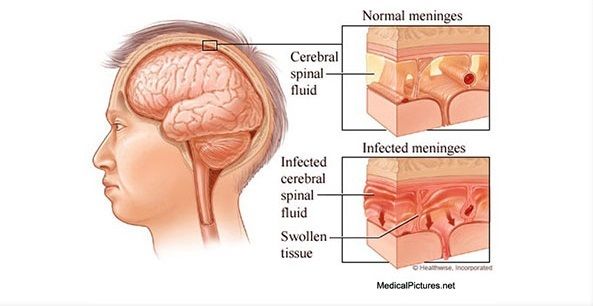 Normal meninges vs infected meninges